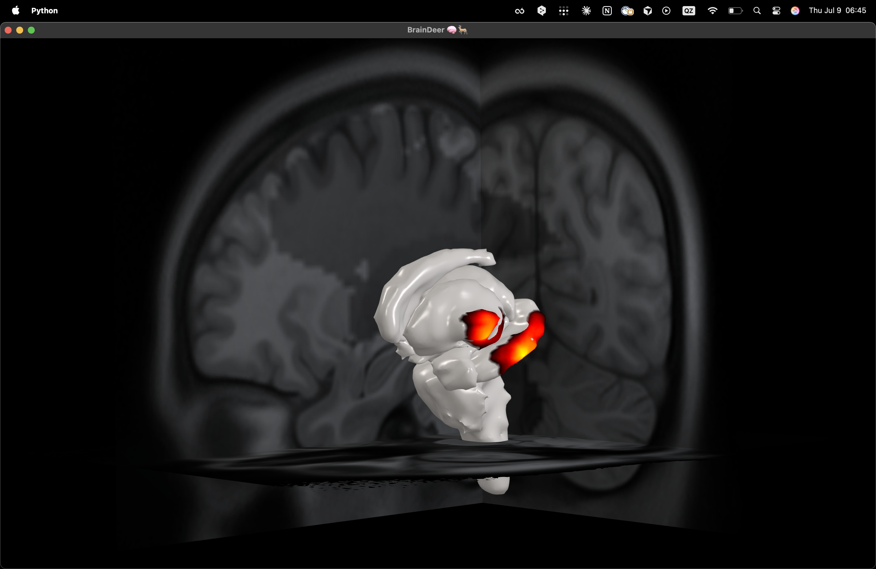 Surface projection heatmap on subcortical anatomy with MRI planes