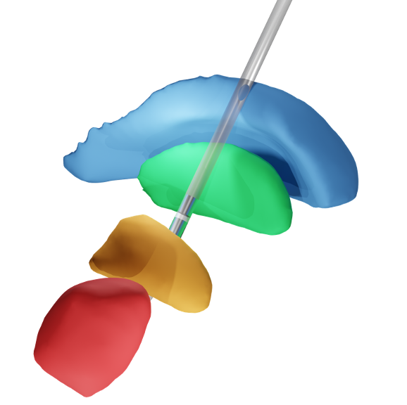 High-resolution Blender render of ROIs and a DBS lead